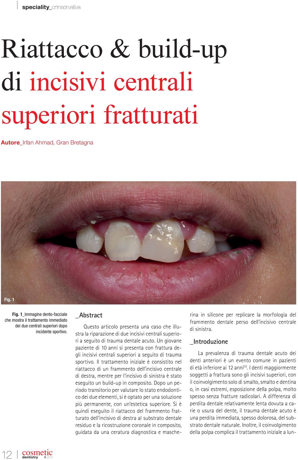 _Abstract Questo articolo presenta una caso che illustra la riparazione di due incisivi centrali superiori a seguito di trauma dentale acuto.