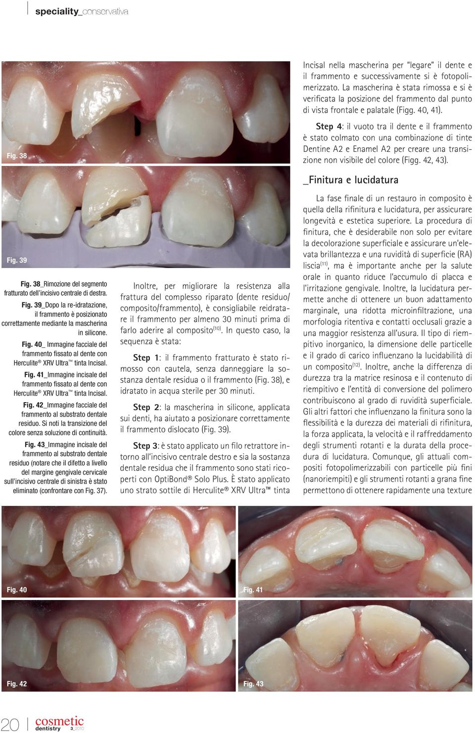 Step 4: il vuoto tra il dente e il frammento è stato colmato con una combinazione di tinte Dentine A2 e Enamel A2 per creare una transizione non visibile del colore (Figg. 42, 43). Fig. 39 Fig.