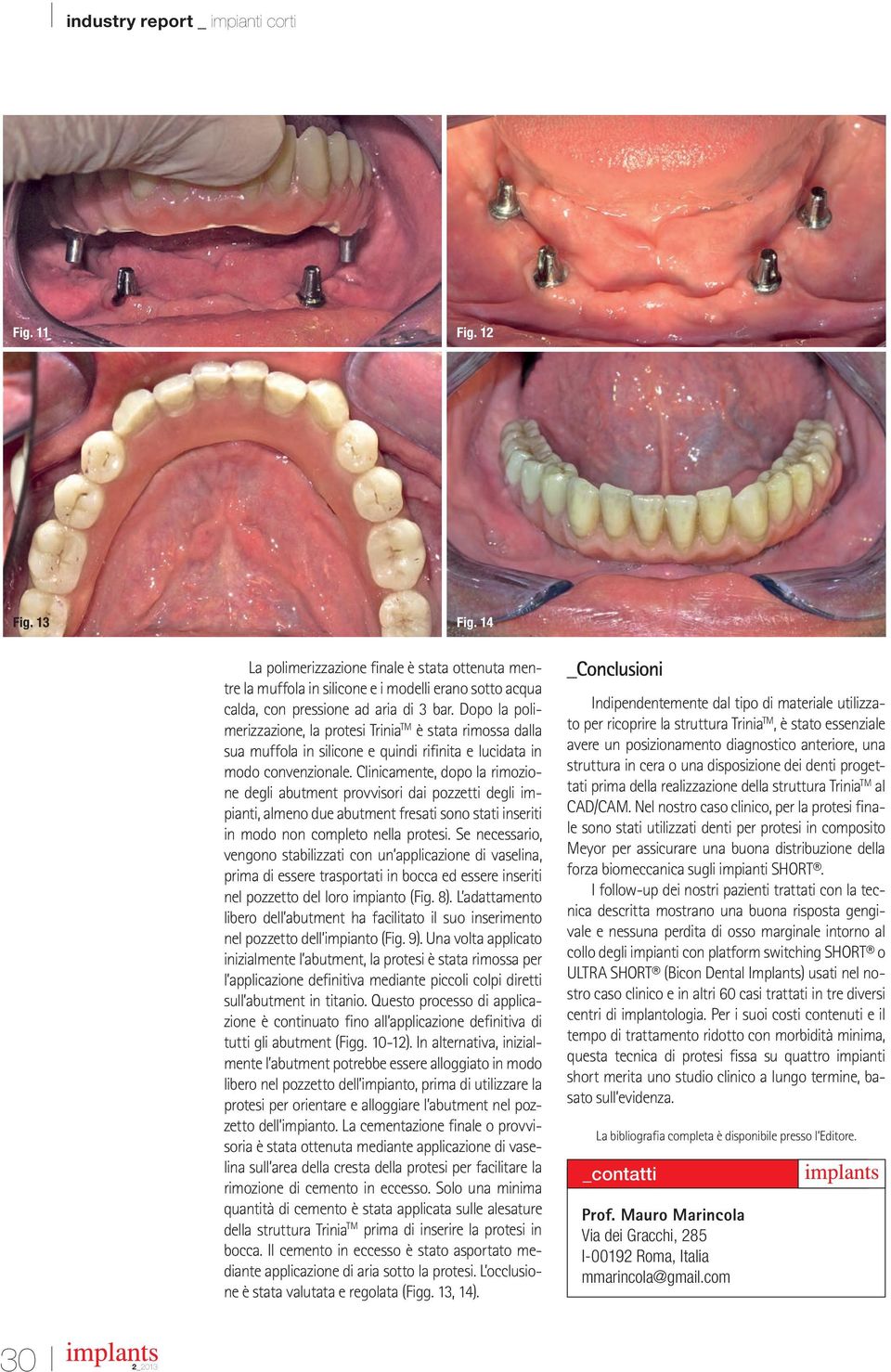 Clinicamente, dopo la rimozione degli abutment provvisori dai pozzetti degli impianti, almeno due abutment fresati sono stati inseriti in modo non completo nella protesi.