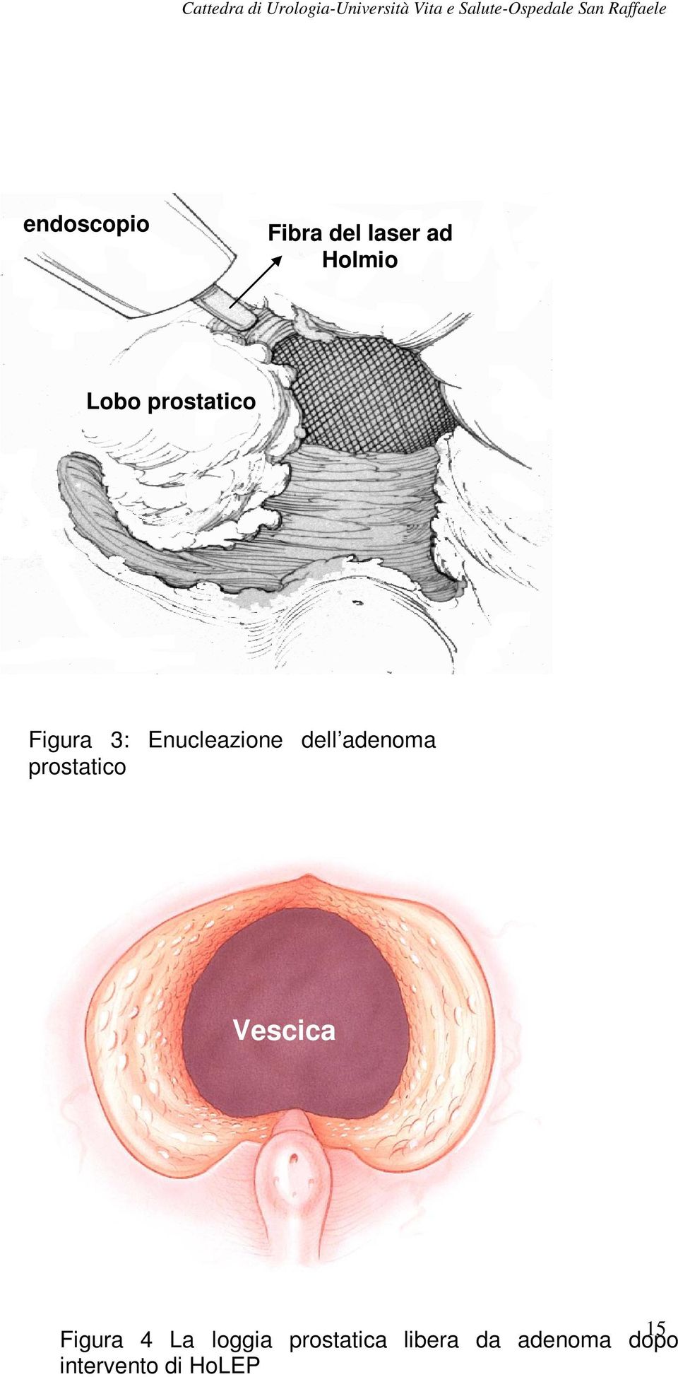 adenoma prostatico Vescica 15 Figura 4 La