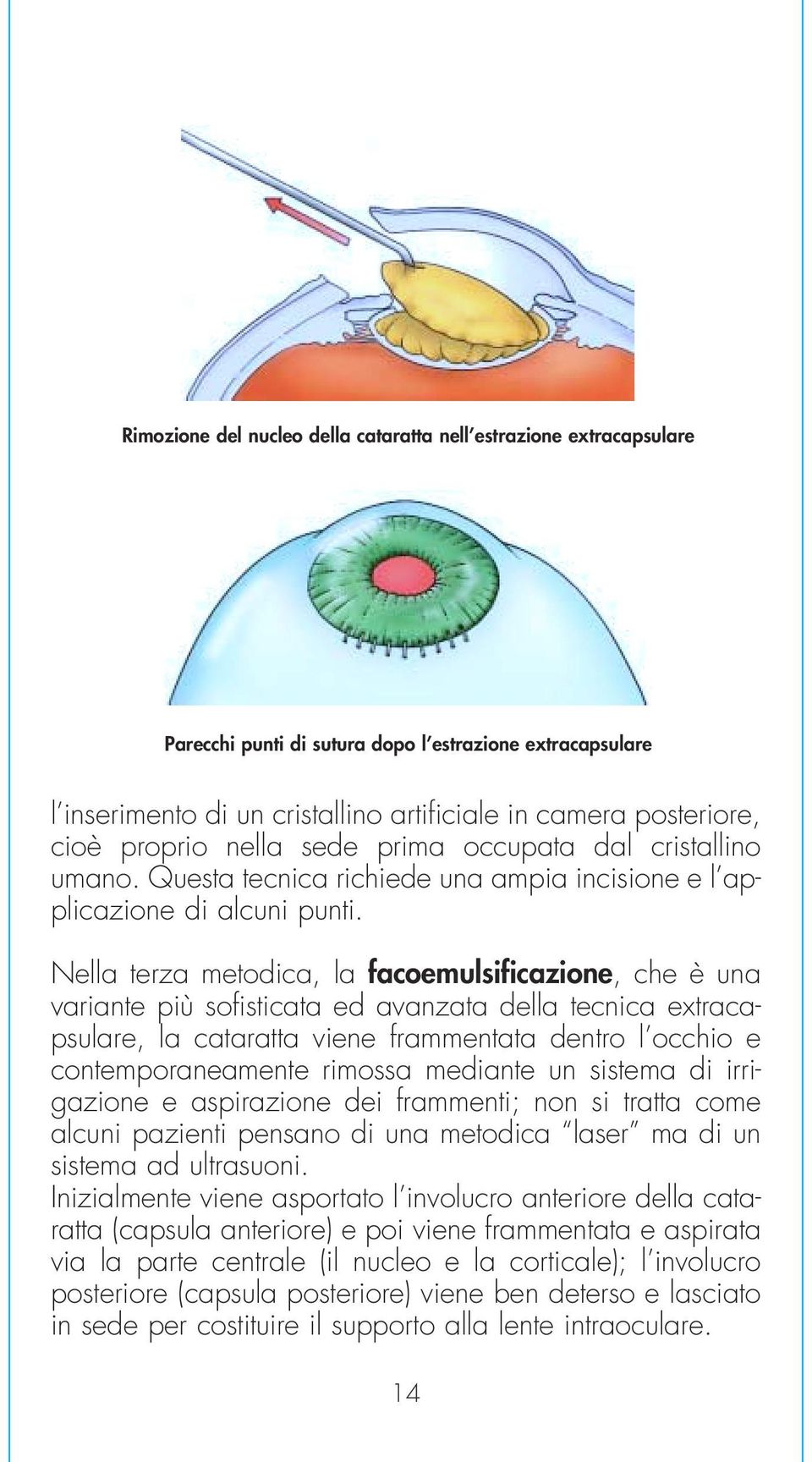 Nella terza metodica, la facoemulsificazione, che è una variante più sofisticata ed avanzata della tecnica extracapsulare, la cataratta viene frammentata dentro l occhio e contemporaneamente rimossa