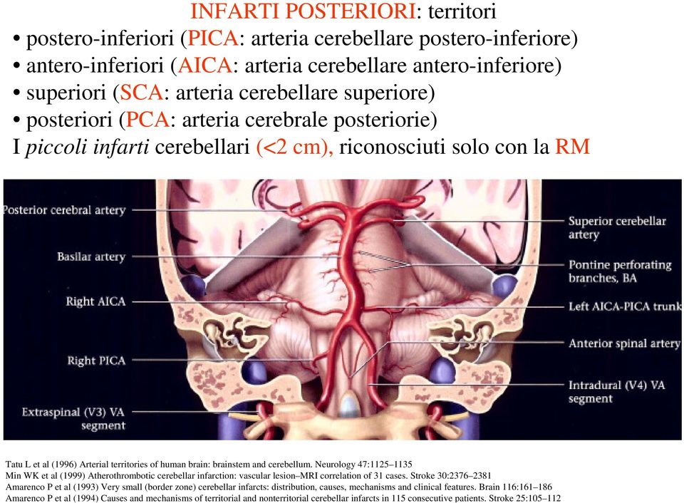 cerebellum. Neurology 47:1125 1135 Min WK et al (1999) Atherothrombotic cerebellar infarction: vascular lesion MRI correlation of 31 cases.