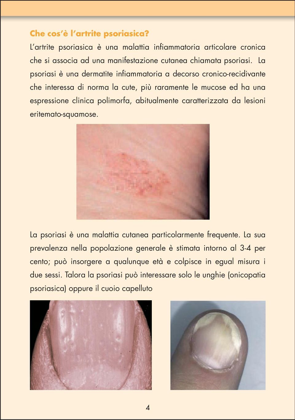 abitualmente caratterizzata da lesioni eritemato-squamose. La psoriasi è una malattia cutanea particolarmente frequente.