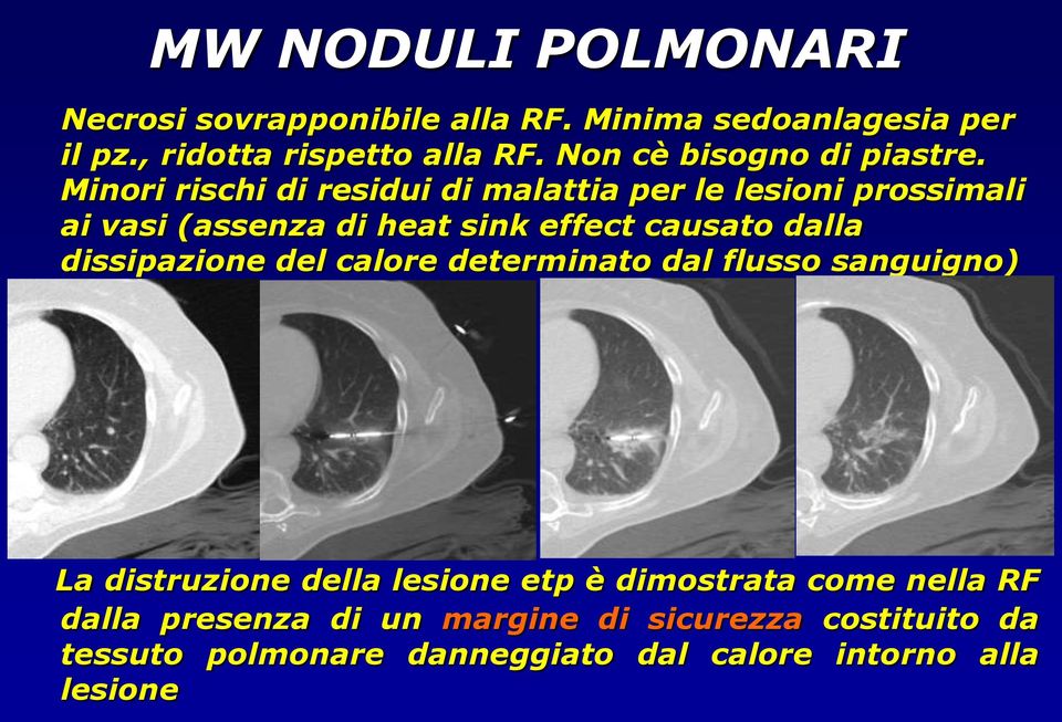 Minori rischi di residui di malattia per le lesioni prossimali ai vasi (assenza di heat sink effect causato dalla