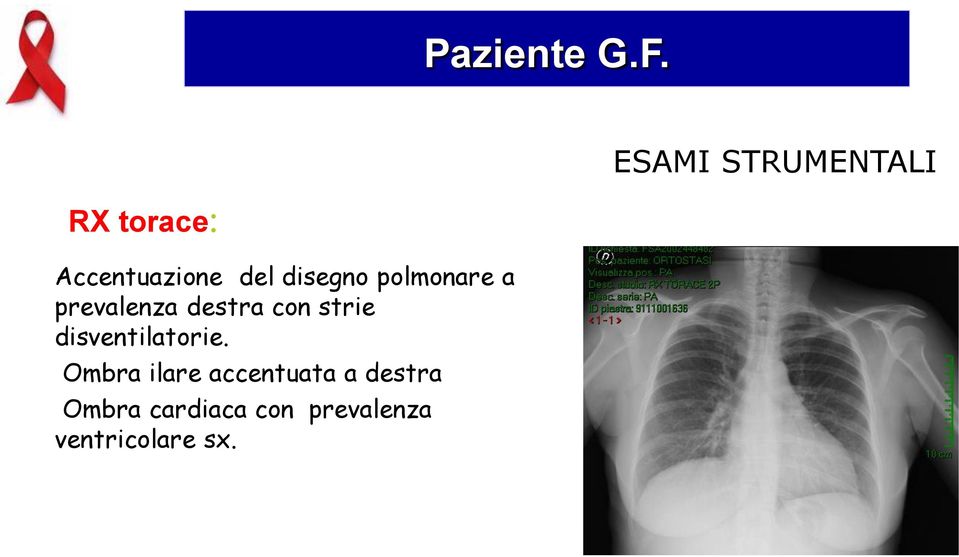 polmonare a prevalenza destra con strie disventilatorie.