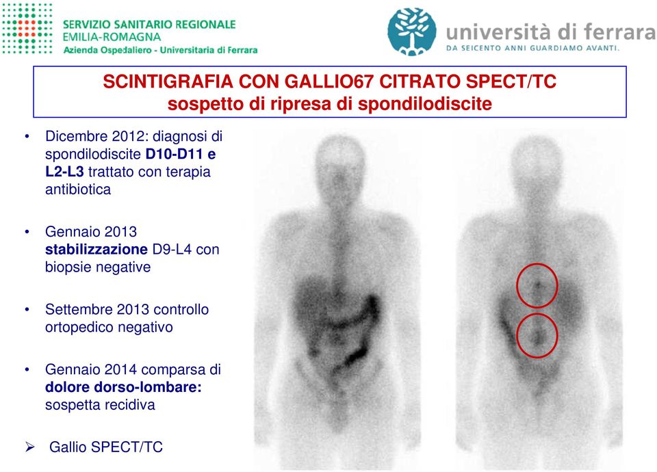 antibiotica Gennaio 2013 stabilizzazione D9-L4 con biopsie negative Settembre 2013