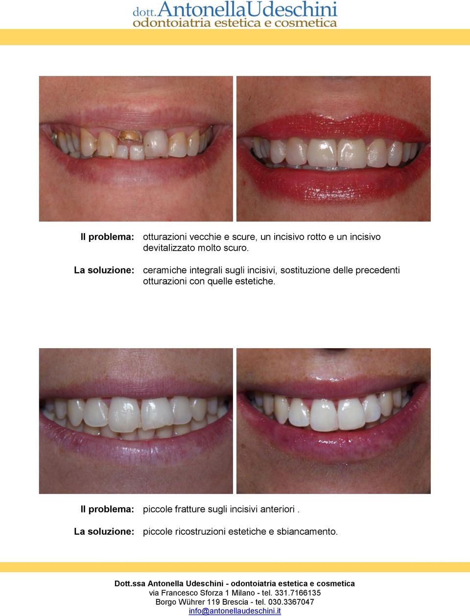La soluzione: ceramiche integrali sugli incisivi, sostituzione delle precedenti