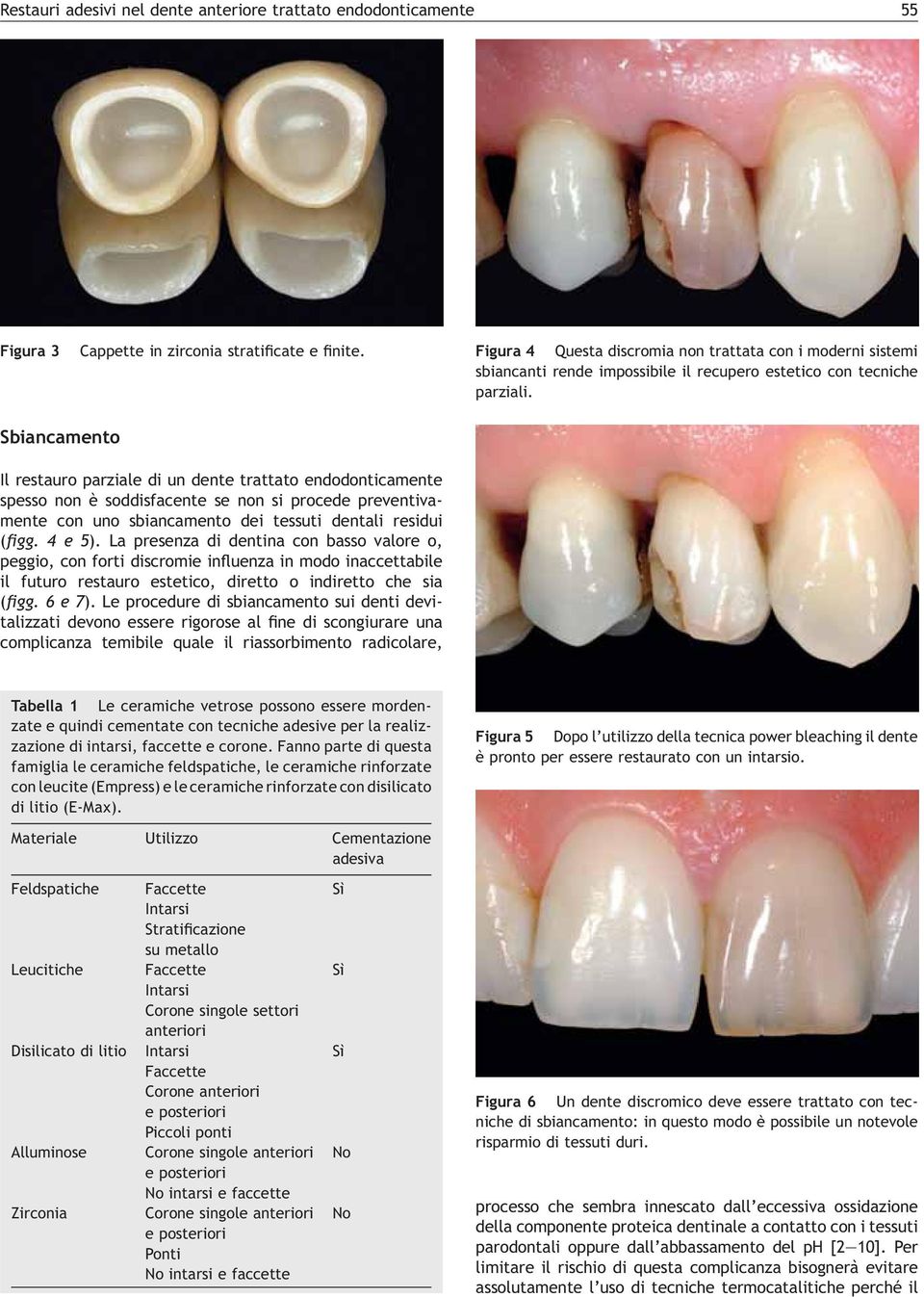 [(Figura_5)TD$FIG] Sbiancamento Il restauro parziale di un dente trattato endodonticamente spesso non è soddisfacente se non si procede preventivamente con uno sbiancamento dei tessuti dentali