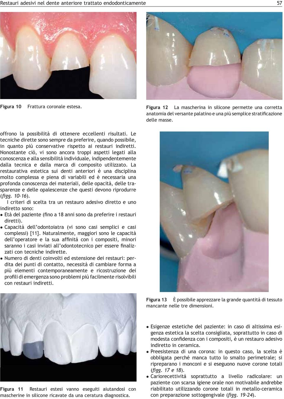 [(Figura_13)TD$FIG] offrono la possibilità di ottenere eccellenti risultati. Le tecniche dirette sono sempre da preferire, quando possibile, in quanto più conservative rispetto ai restauri indiretti.