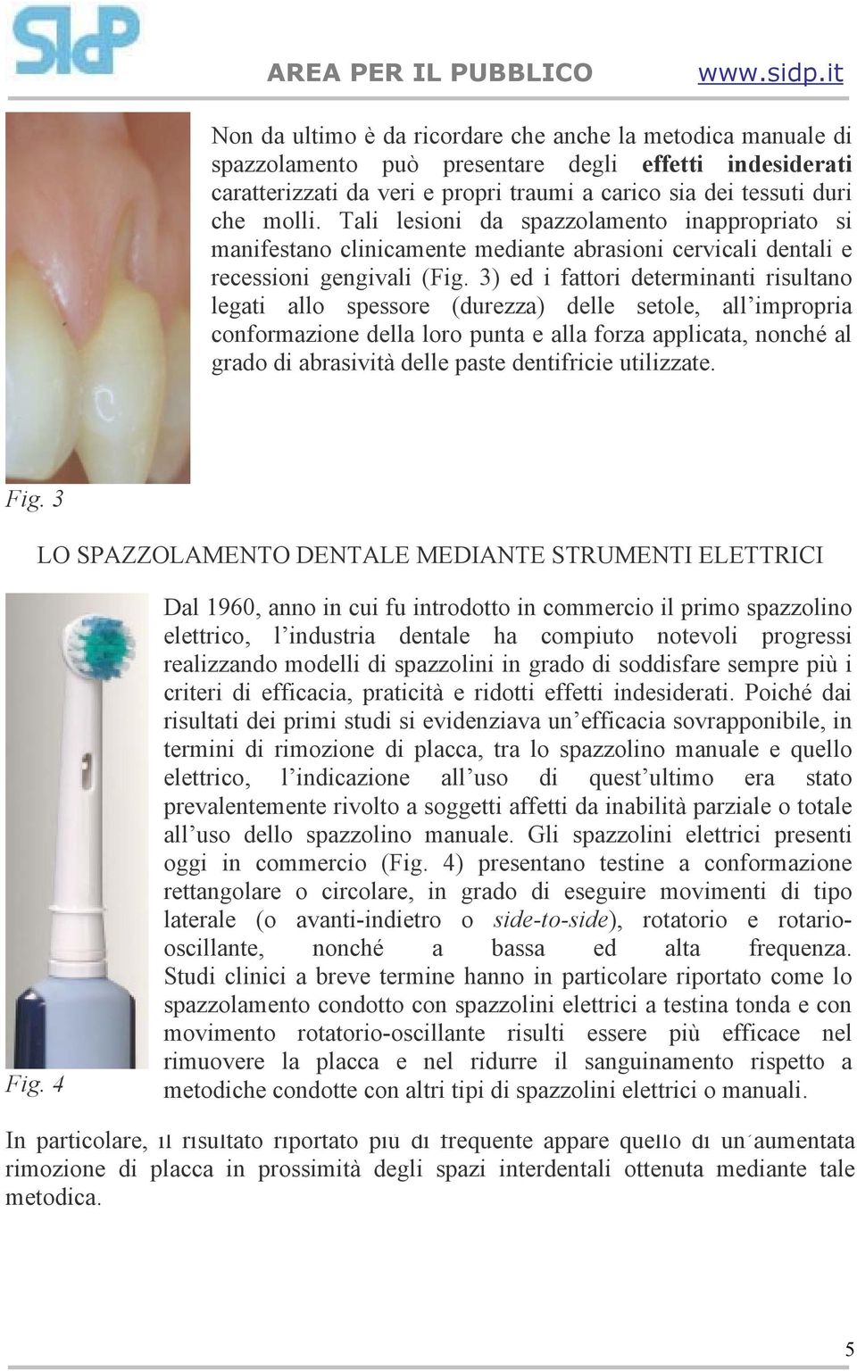 3) ed i fattori determinanti risultano legati allo spessore (durezza) delle setole, all impropria conformazione della loro punta e alla forza applicata, nonché al grado di abrasività delle paste