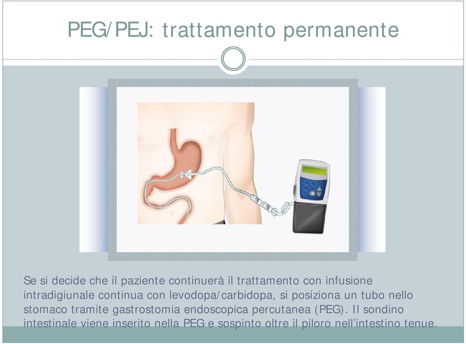 posiziona un tubo nello stomaco tramite gastrostomia endoscopica percutanea (PEG).