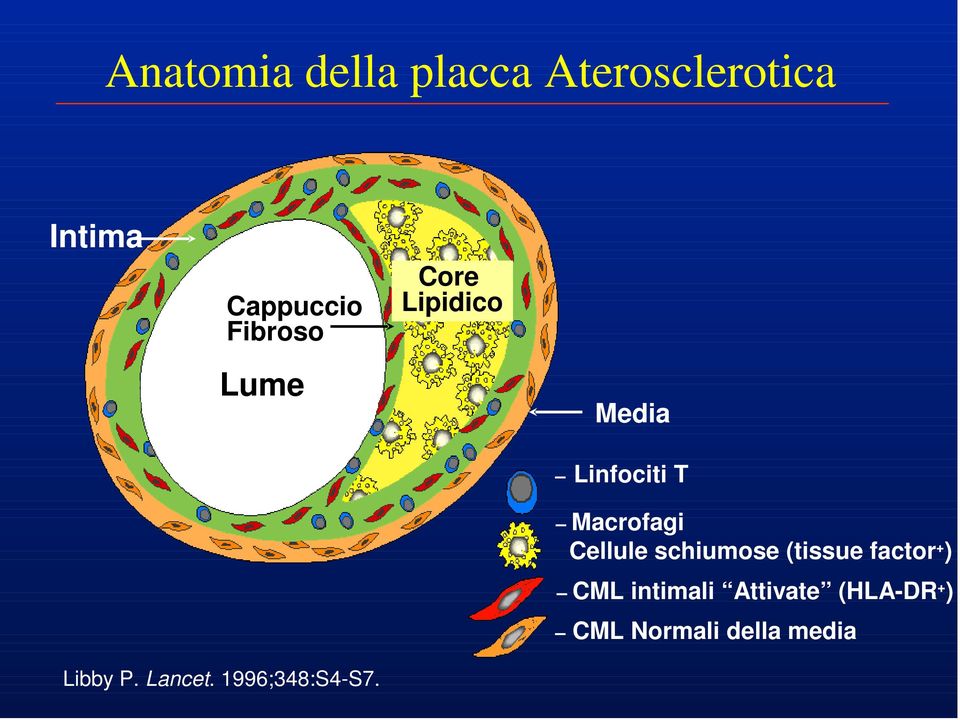 Cellule schiumose (tissue factor + ) CML intimali Attivate