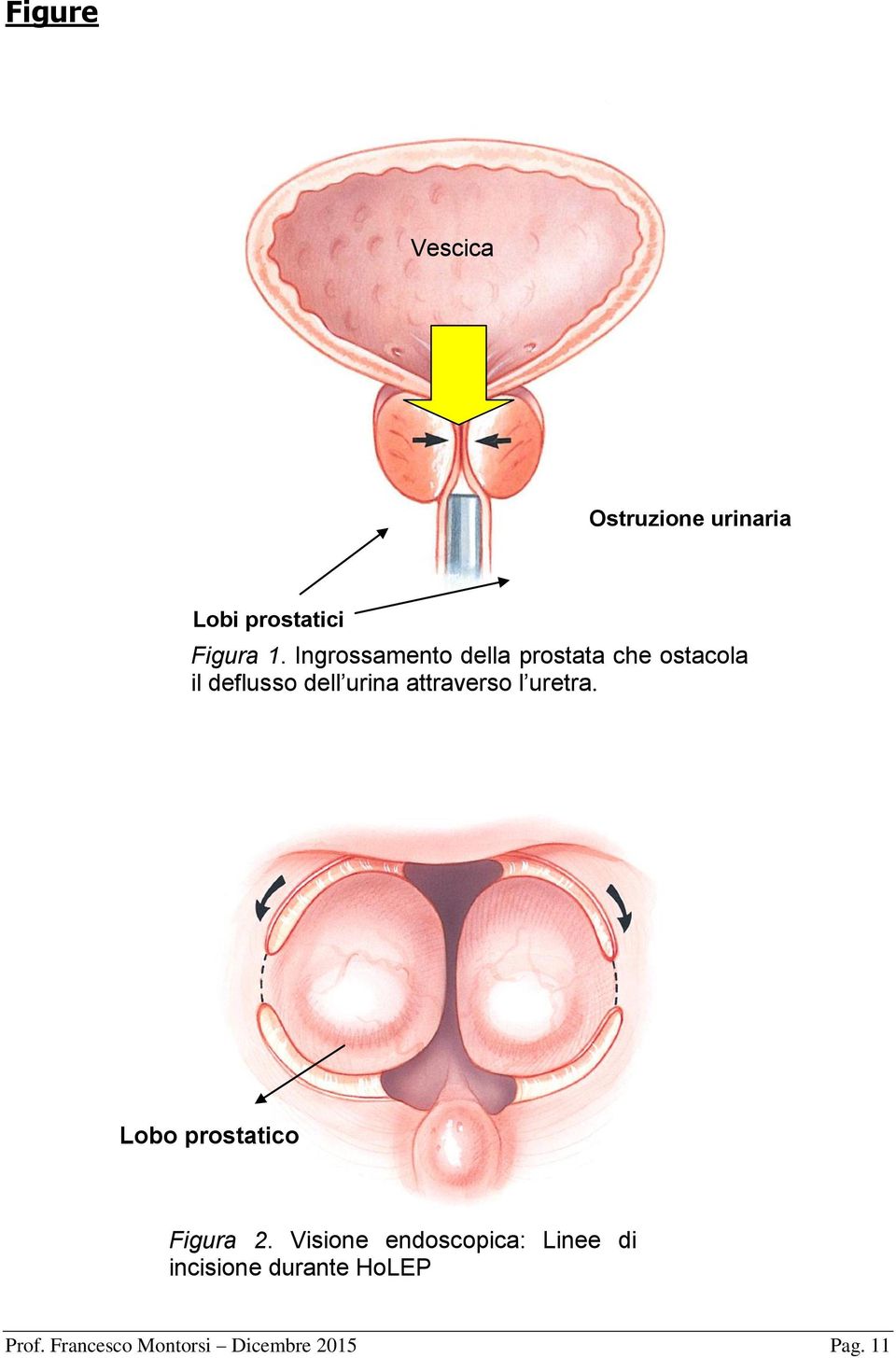 attraverso l uretra. Lobo prostatico Figura 2.