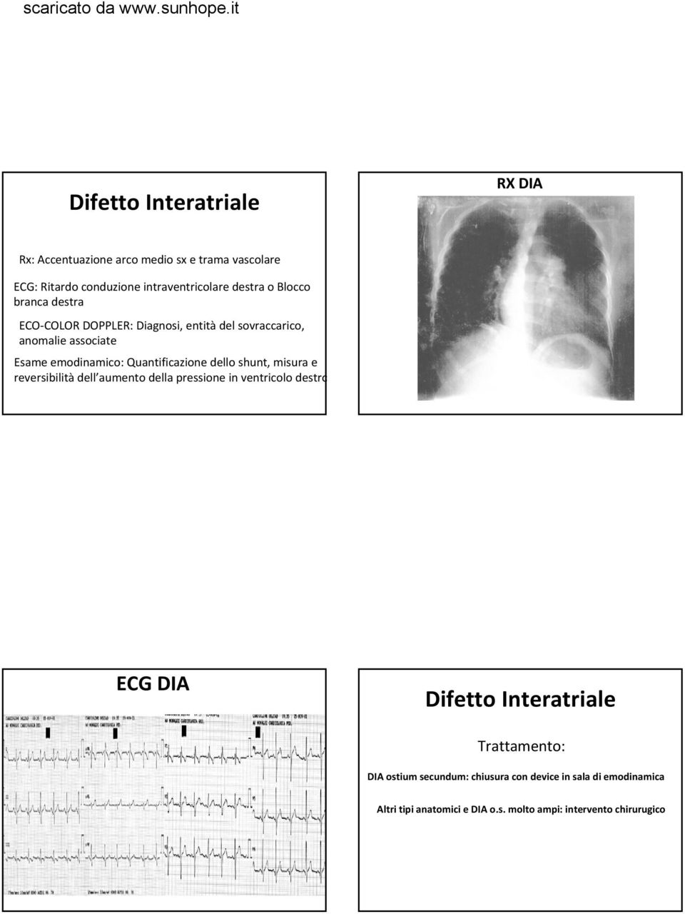 dello shunt, misura e reversibilità dell aumento della pressione in ventricolo destro ECG DIA Difetto Interatriale Trattamento: