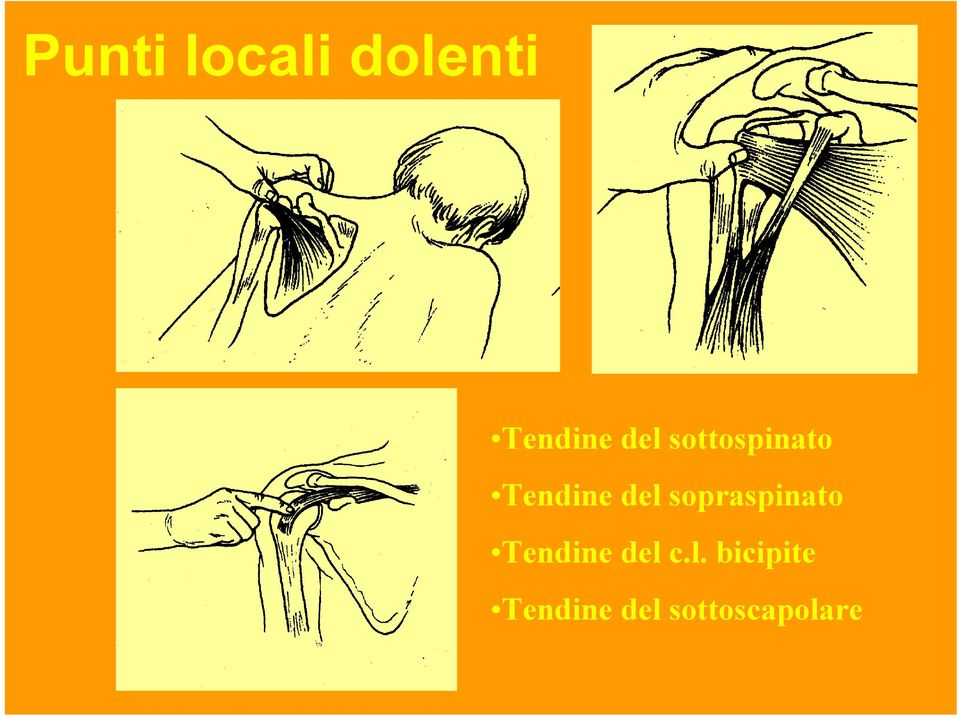 sopraspinato Tendine del 