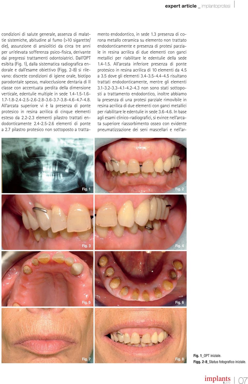 2-8) si rilevano: discrete condizioni di igiene orale, biotipo parodontale spesso, malocclusione dentaria di II classe con accentuata perdita della dimensione verticale, edentulie multiple in sede 1.