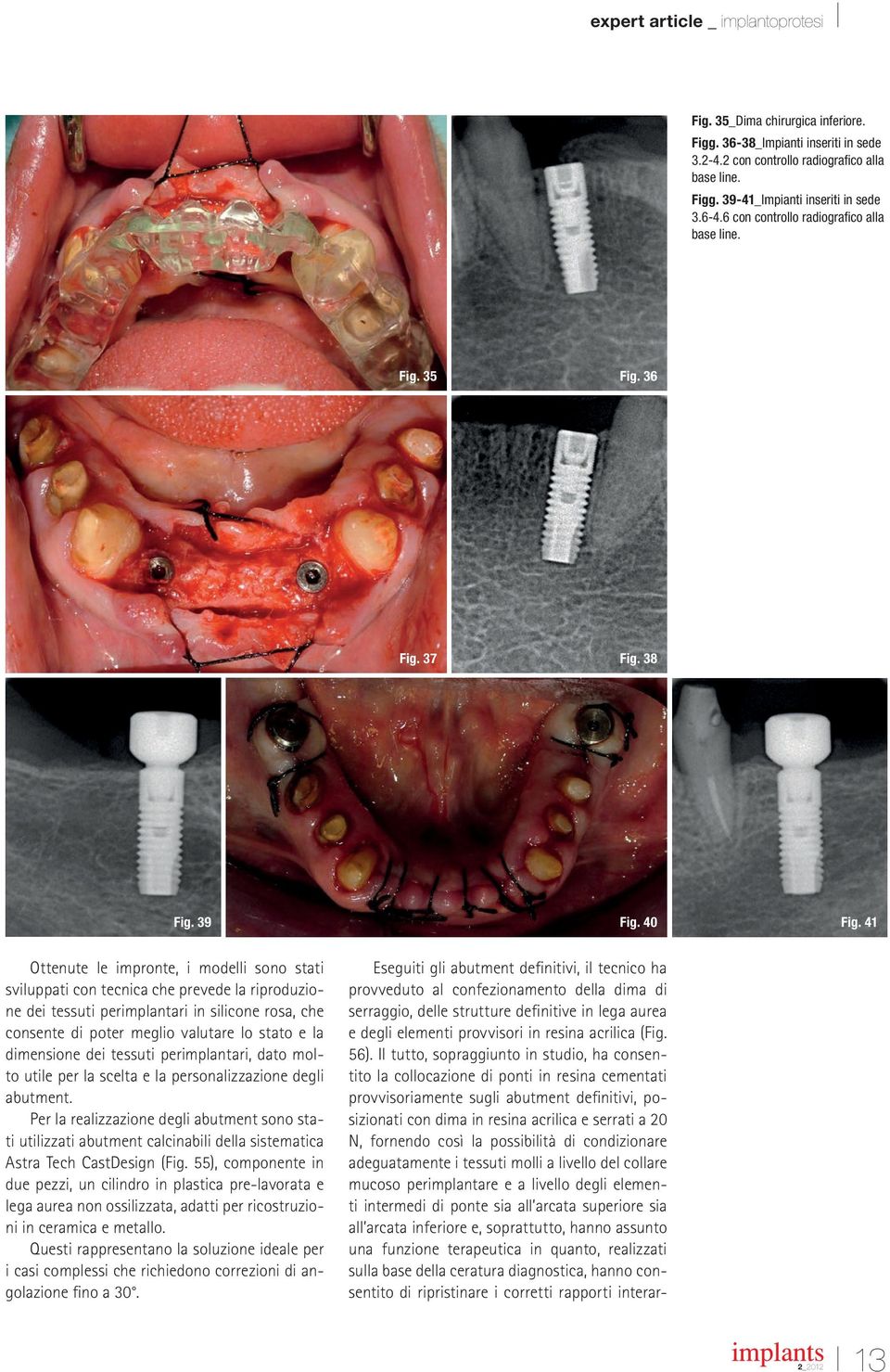 41 Ottenute le impronte, i modelli sono stati sviluppati con tecnica che prevede la riproduzione dei tessuti perimplantari in silicone rosa, che consente di poter meglio valutare lo stato e la