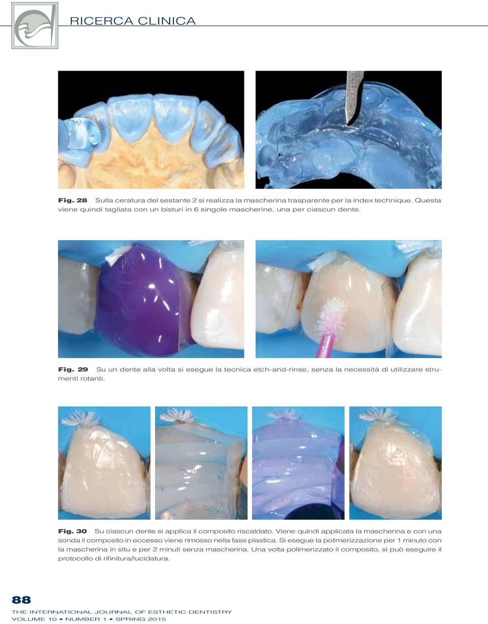 29 Su un dente alla volta si esegue la tecnica etch-and-rinse, senza la necessità di utilizzare strumenti rotanti. Fig. 30 Su ciascun dente si applica il composito riscaldato.