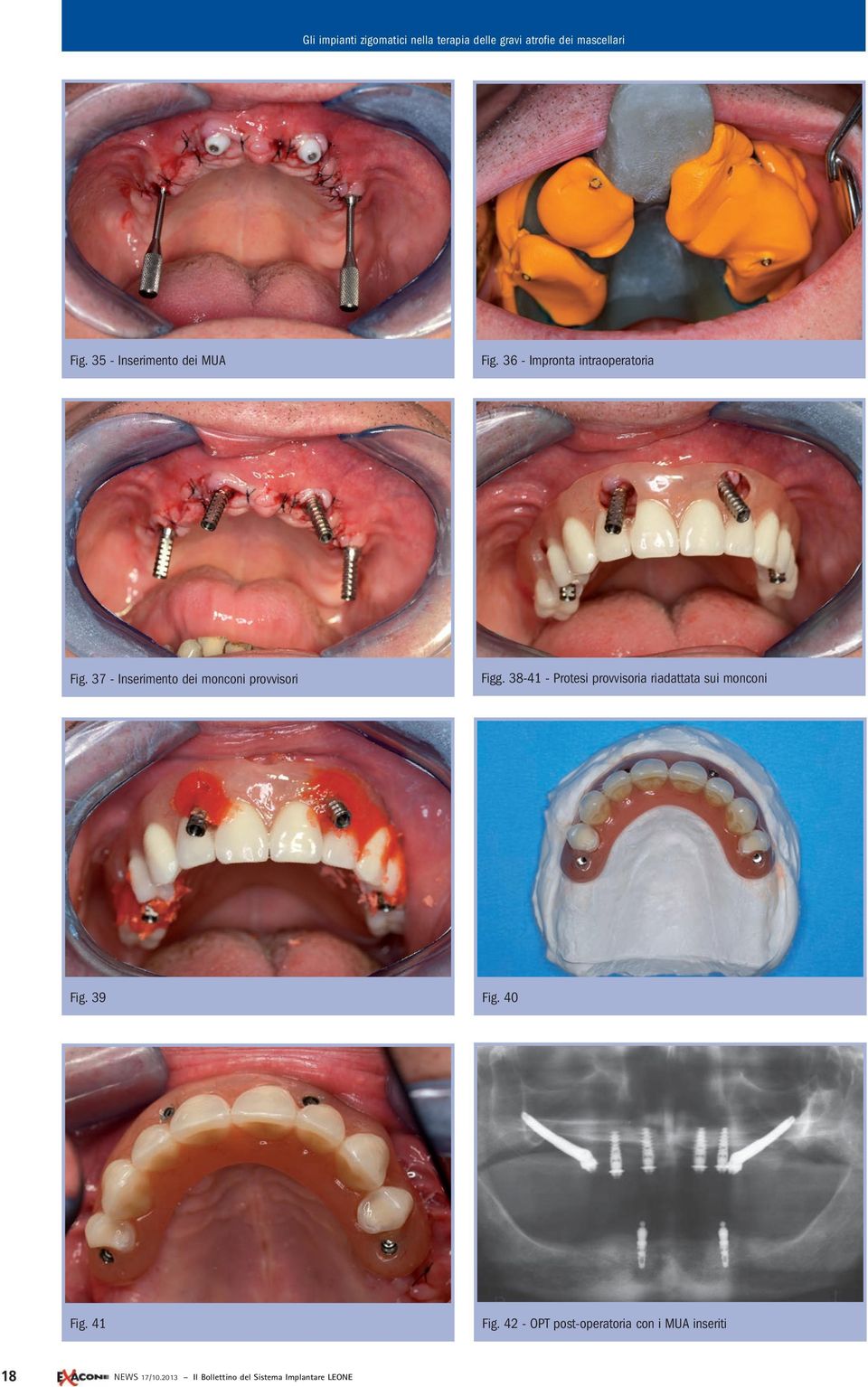 38-41 - Protesi provvisoria riadattata sui monconi Fig. 39 Fig. 40 Fig.