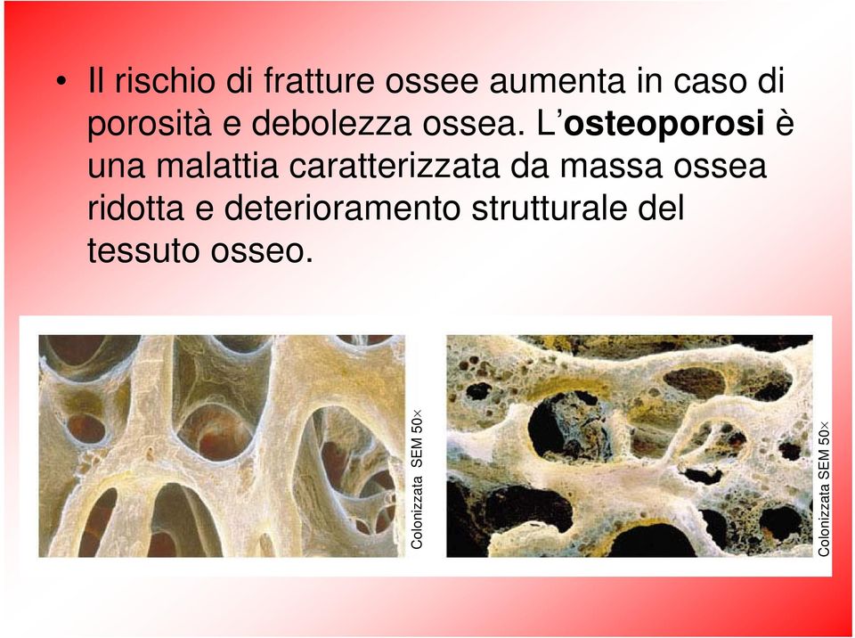 L osteoporosi è una malattia caratterizzata da massa