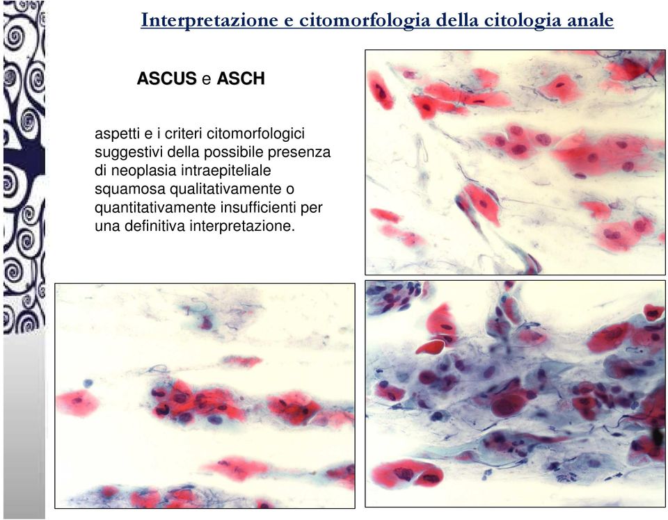 possibile presenza di neoplasia intraepiteliale squamosa