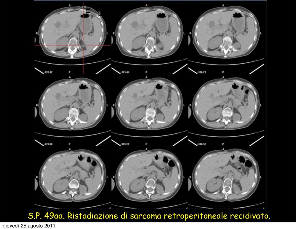 sarcoma