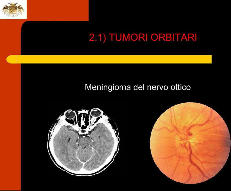 Meningioma