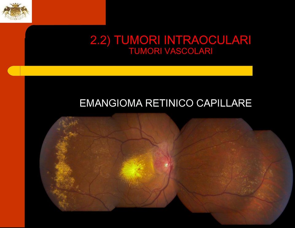 EMANGIOMA