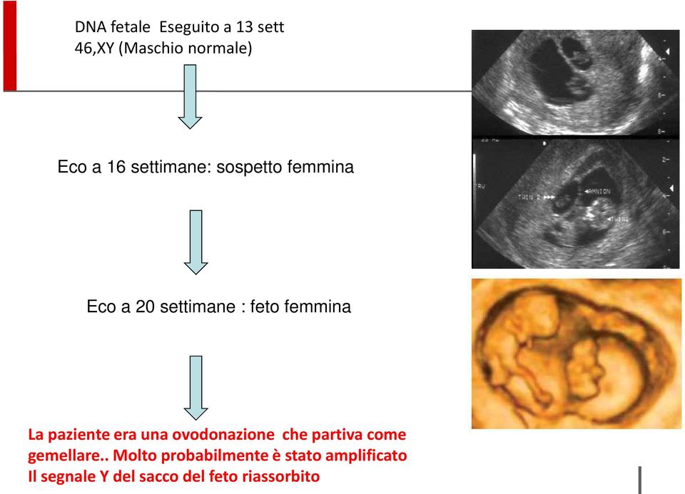 paziente era una ovodonazione che partiva come gemellare.