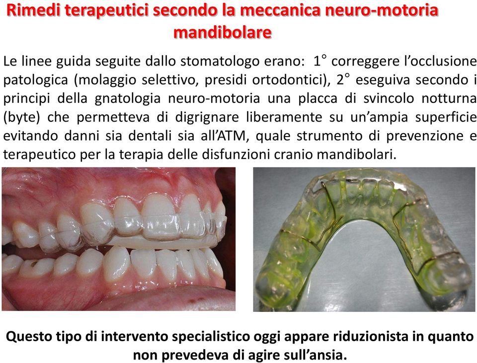 permetteva di digrignare liberamente su un ampia superficie evitando danni sia dentali sia all ATM, quale strumento di prevenzione e terapeutico per la