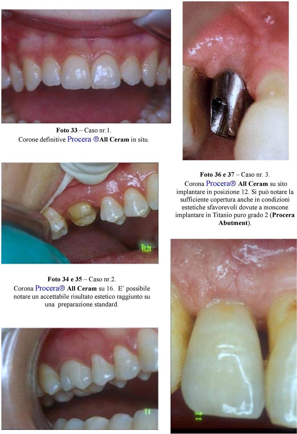 Titanio puro grado 2 (Procera Abutment). Foto 34 e 35 Caso nr.2. Corona Procera All Ceram su 16.