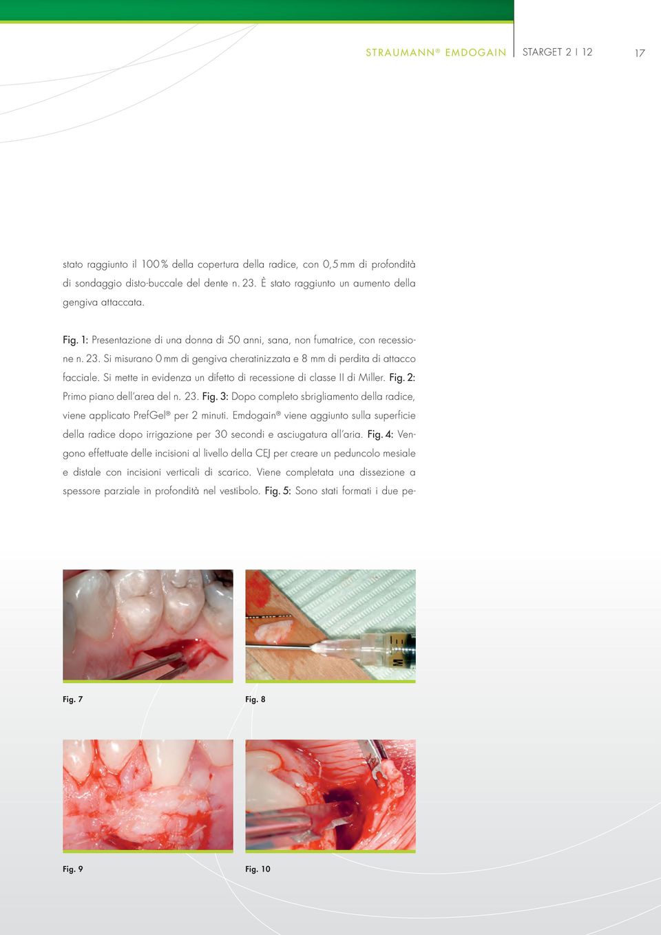 Si misurano 0 mm di gengiva cheratinizzata e 8 mm di perdita di attacco facciale. Si mette in evidenza un difetto di recessione di classe II di Miller. Fig.