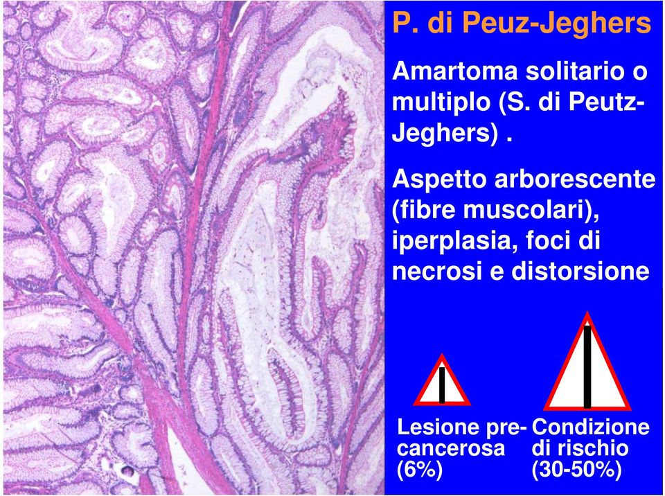 Aspetto arborescente (fibre muscolari), iperplasia,