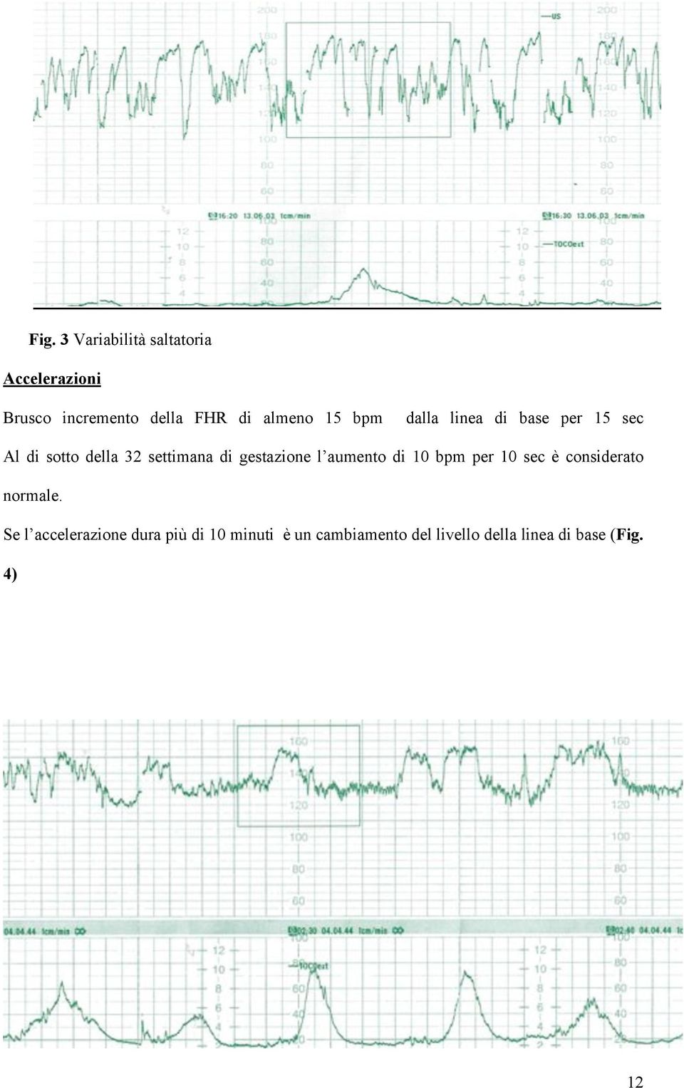 gestazione l aumento di 10 bpm per 10 sec è considerato normale.