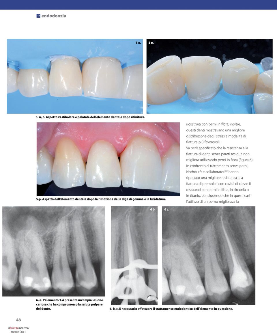 Va però specificato che la resistenza alla frattura di denti senza pareti residue non migliora utilizzando perni in fibra (figura 6).