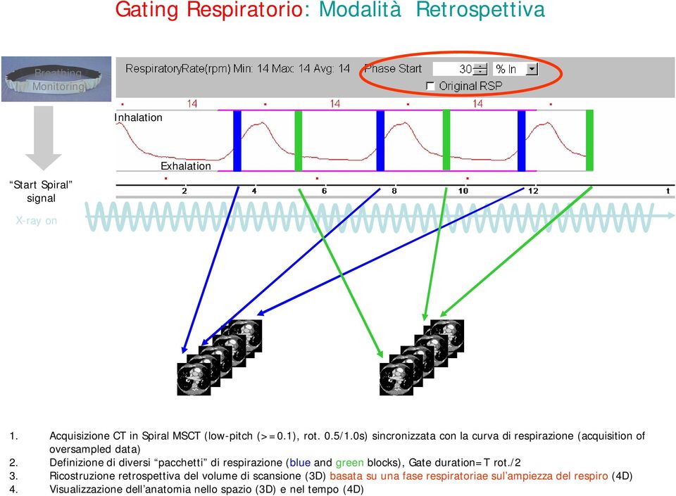 0s) sincronizzata con la curva di respirazione (acquisition of oversampled data) 2.