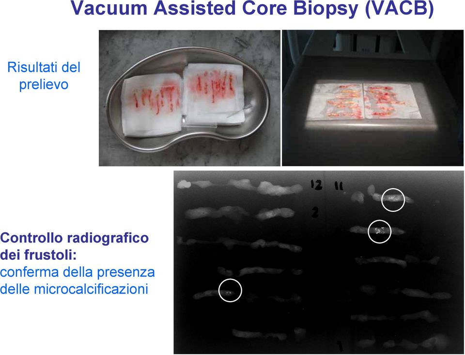 radiografico dei frustoli: conferma