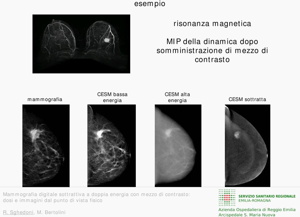 mezzo di contrasto mammografia CESM