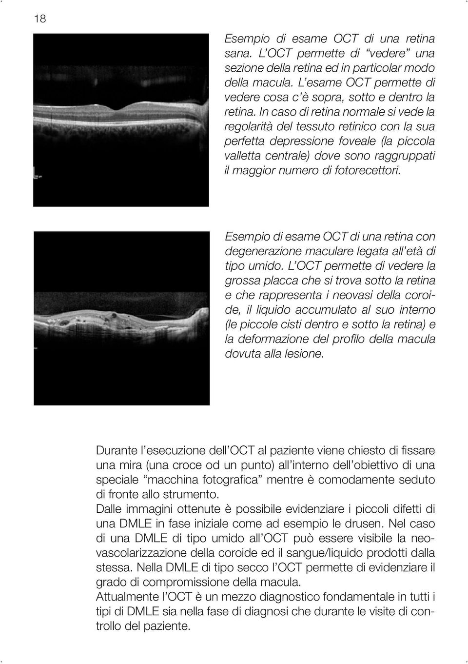 In caso di retina normale si vede la regolarità del tessuto retinico con la sua perfetta depressione foveale (la piccola valletta centrale) dove sono raggruppati il maggior numero di fotorecettori.