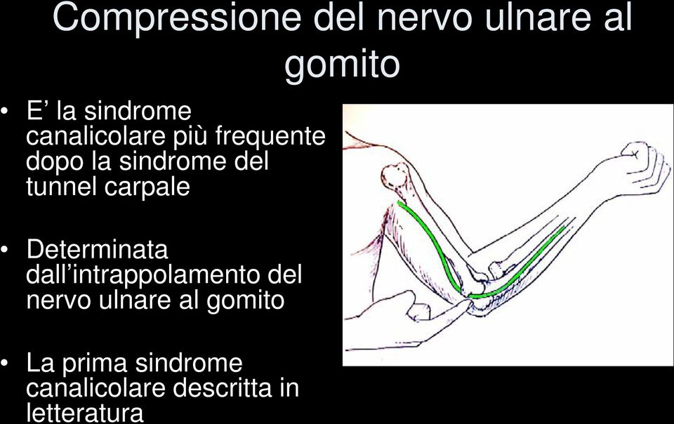 carpale Determinata dall intrappolamento del nervo ulnare