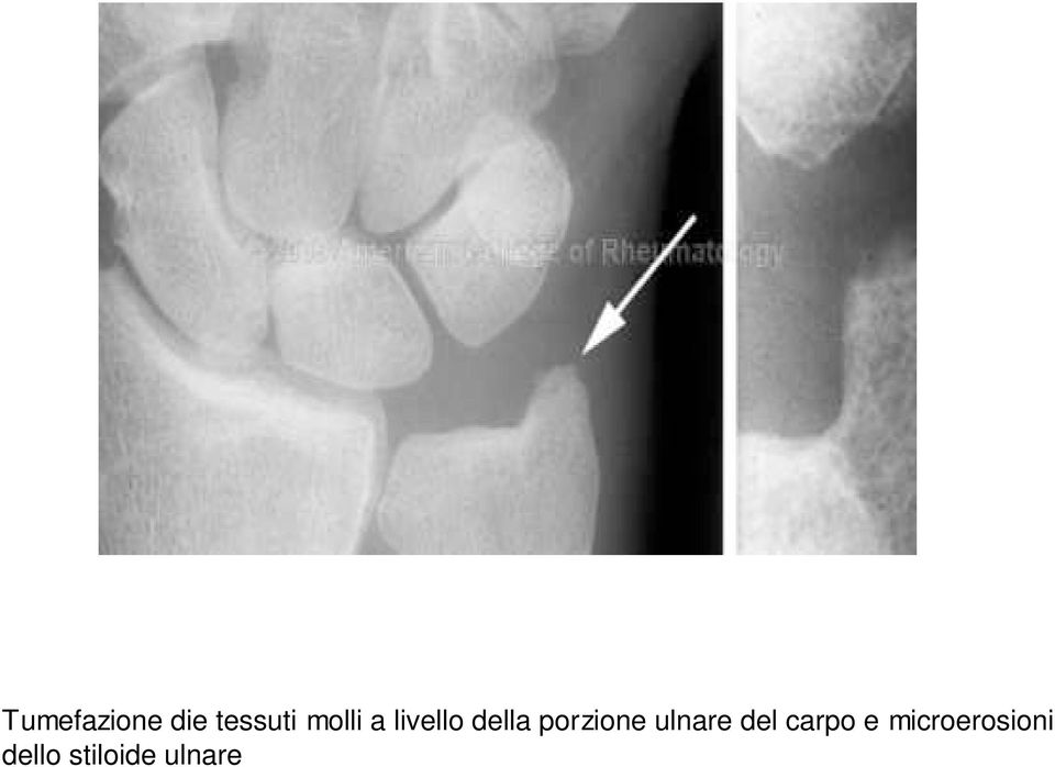 porzione ulnare del carpo e