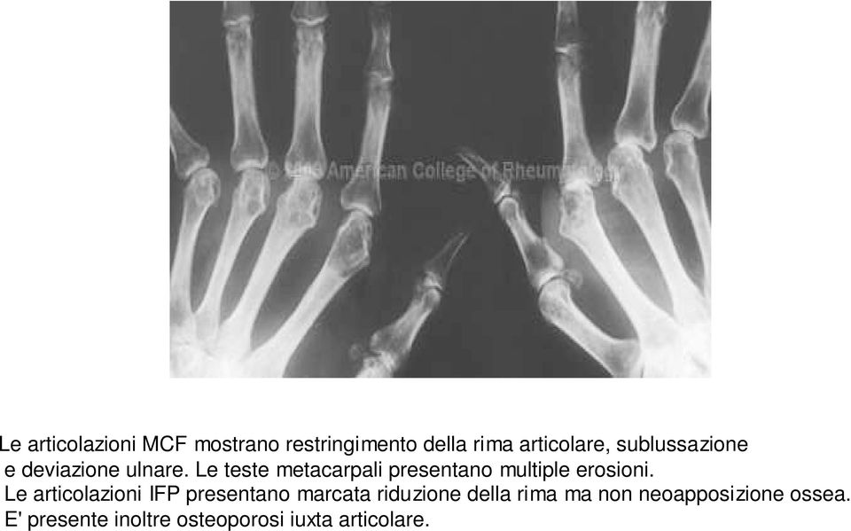 Le teste metacarpali presentano multiple erosioni.