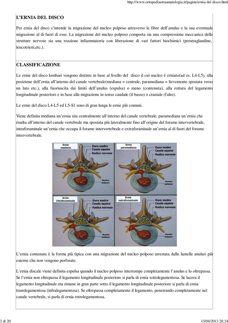 leucotrieni,etc.). CLASSIFICAZIONE Le ernie del disco lombari vengono distinte in base al livello del disco il cui nucleo è erniato(ad es.