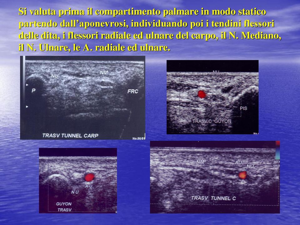 tendini flessori delle dita, i flessori radiale ed