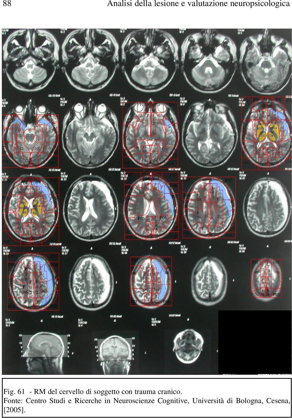 6 - RM del cervello di soggetto con trauma cranico.