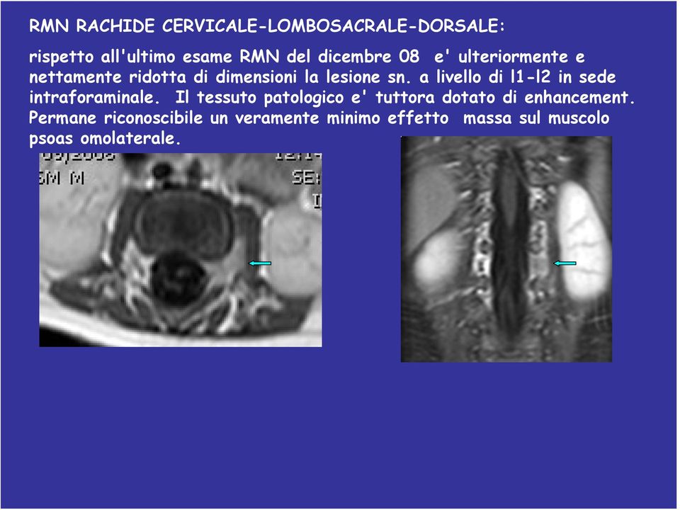 a livello di l1-l2 in sede intraforaminale.