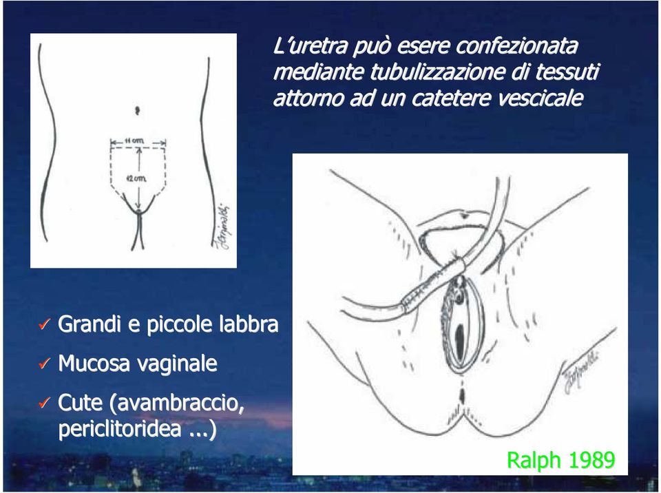 catetere vescicale Grandi e piccole labbra