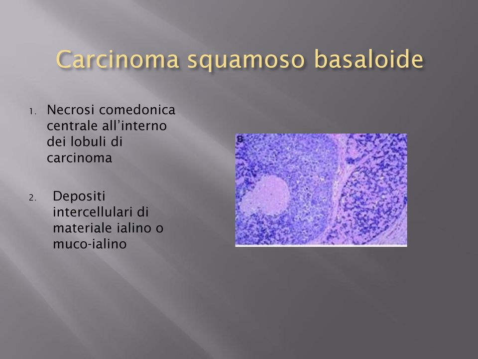 interno dei lobuli di carcinoma 2.