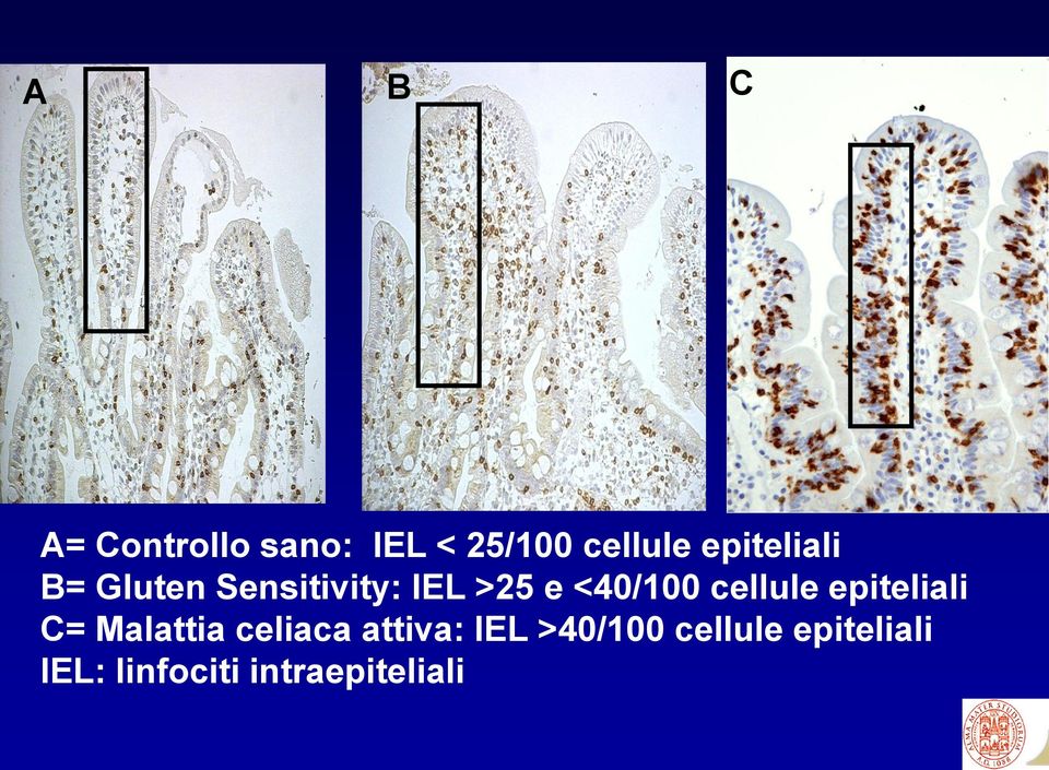 cellule epiteliali C= Malattia celiaca attiva: IEL