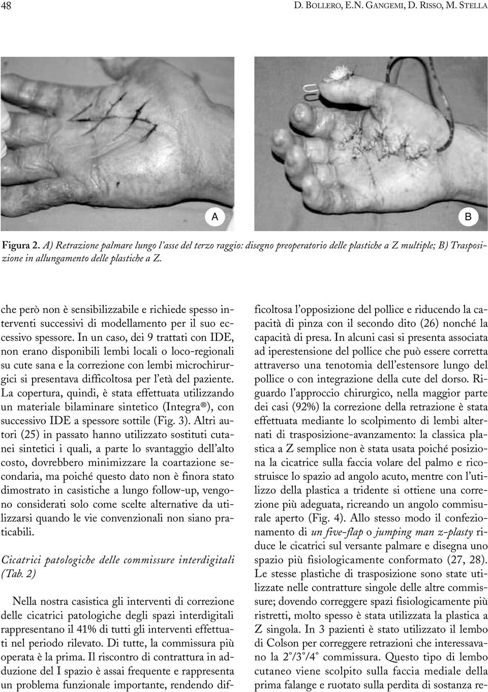 che però non è sensibilizzabile e richiede spesso interventi successivi di modellamento per il suo eccessivo spessore.